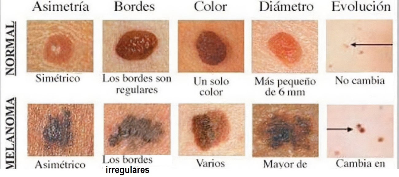 Dia Mundial de la lucha contra el Melanoma